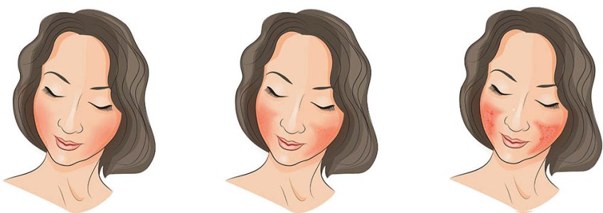 rosacea-illustration-506851.jpg