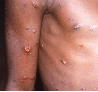 MPox Lesions.PNG