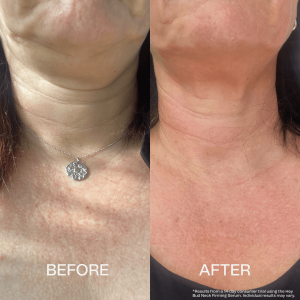 heybud_neck_beforeafter5.png