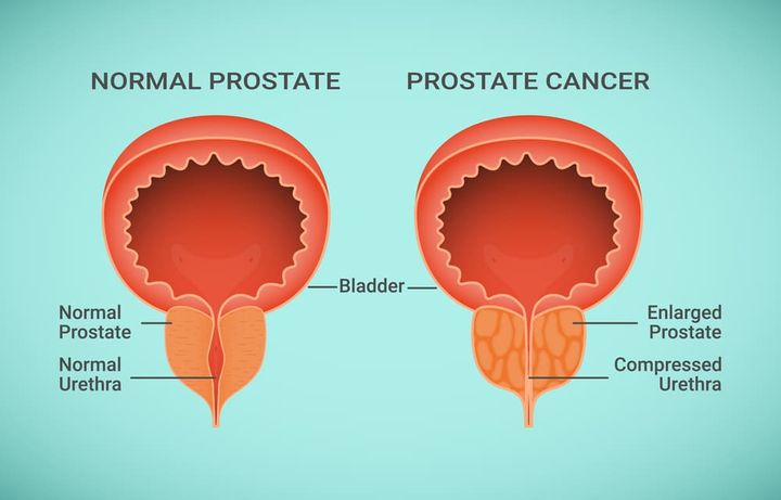 prostate.jpg